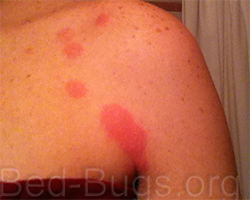 Image of bite from a bed bug